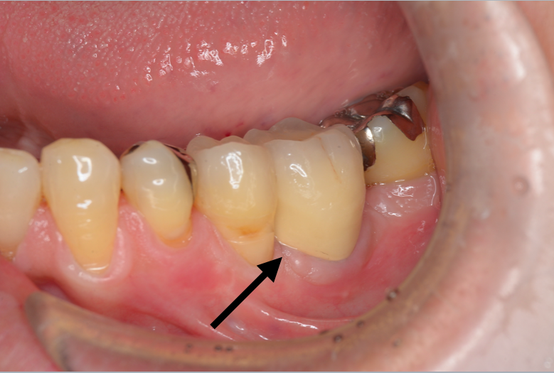 移植歯　補綴後３年経過時の写真です