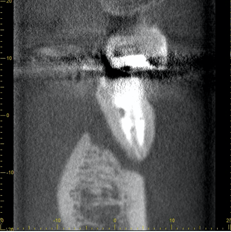 歯根破折した歯のCBCT画像です。周囲の骨吸収が著明なのが分かります。
