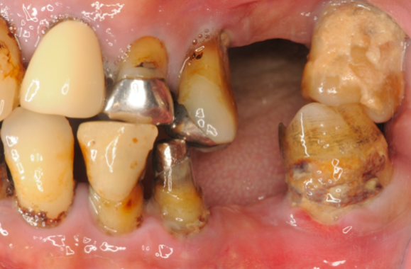 左側臼歯部｜歯肉の腫れが強い状態