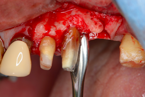 エムドゲイン・自家骨移植による歯周組織再生治療