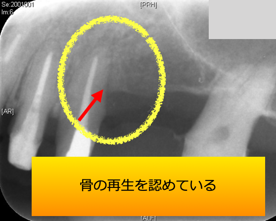 術後半年