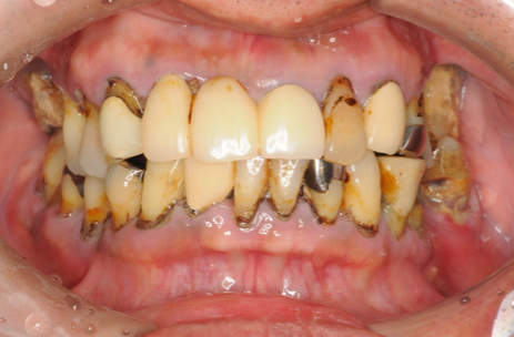 初診時の口腔内写真