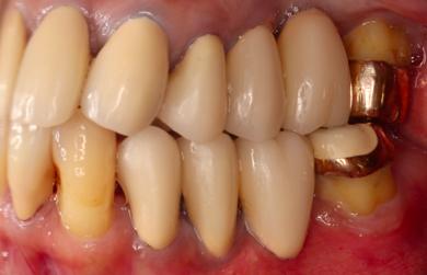 左側臼歯部｜メインテナンス時（治療後5年）