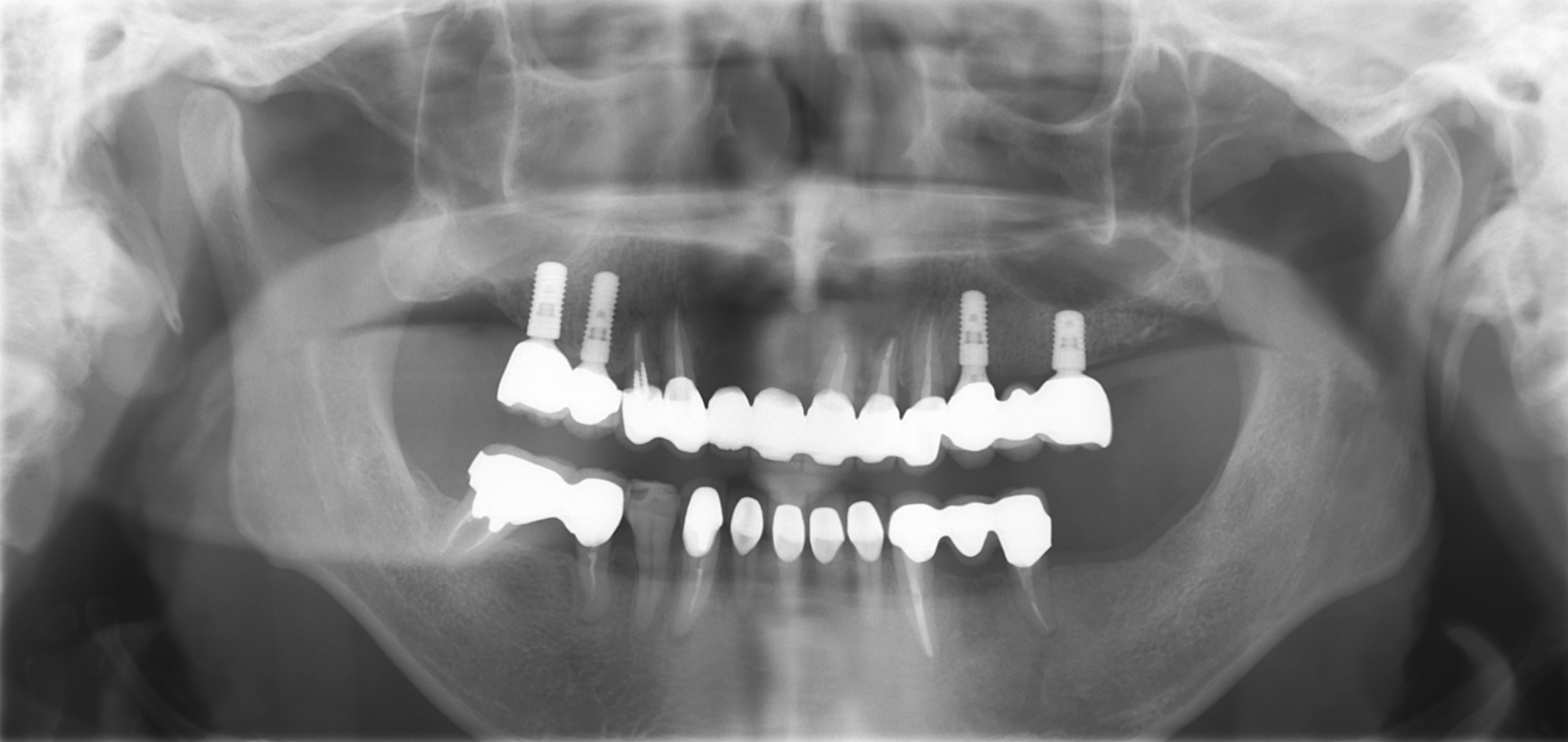 インプラント埋入後のエックス線写真