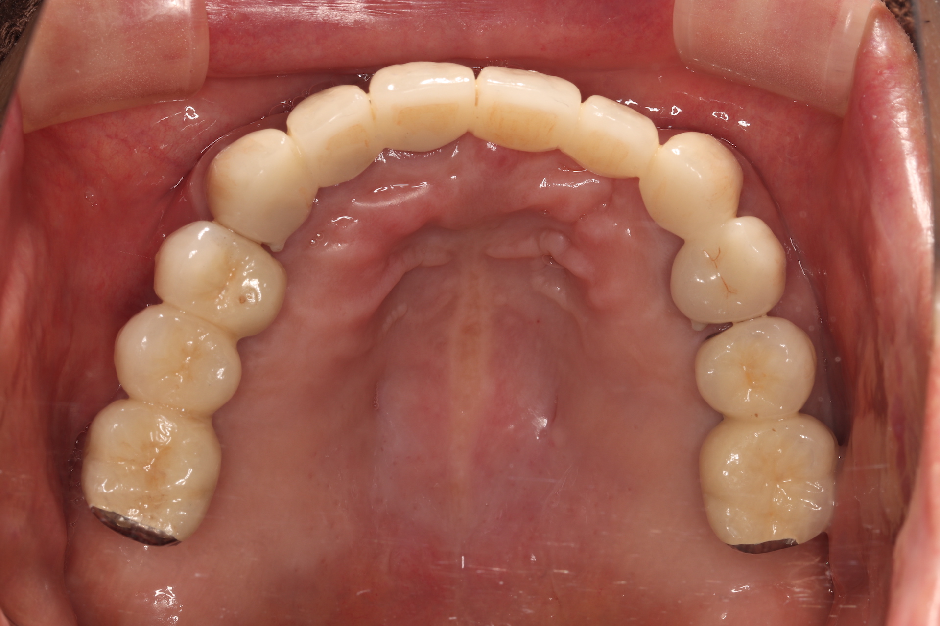 インプラント治療| 臼歯部多数歯欠損患者に対する咬合再構成｜これまで 