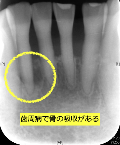 歯周病の進行による骨吸収を認める