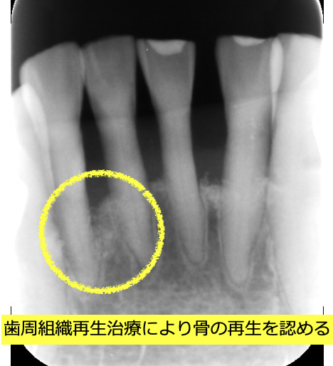 歯周組織再生治療後