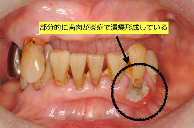 初診時には歯肉の炎症が強く出ており、一部歯肉の潰瘍形成も認める
