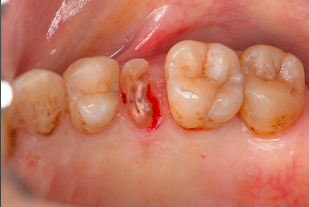 初診時：歯が割れた状態で来院