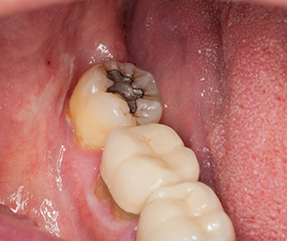 銀歯には金属アレルギーのリスクもあります