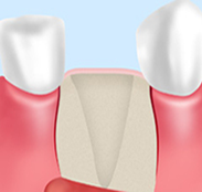 step1 歯茎の切開