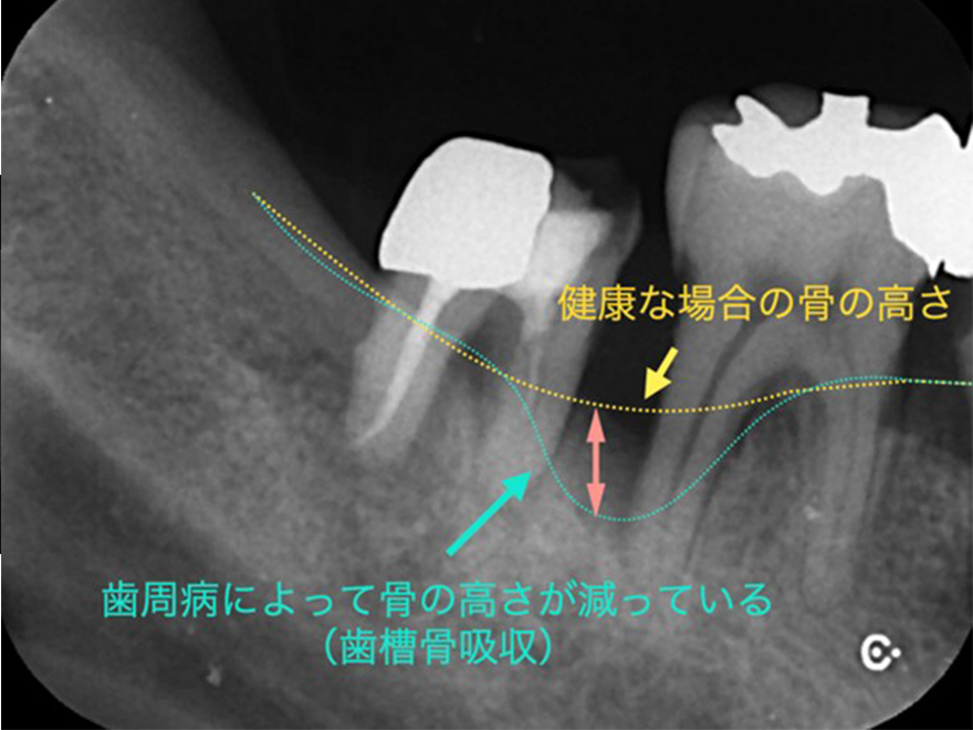 歯周病ってどう判断するの？